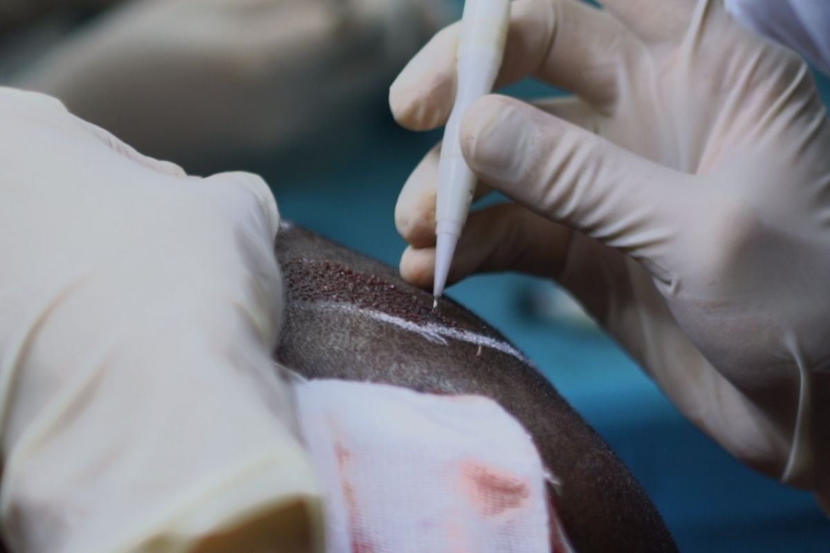 Basic Hair Transplant in Madurai