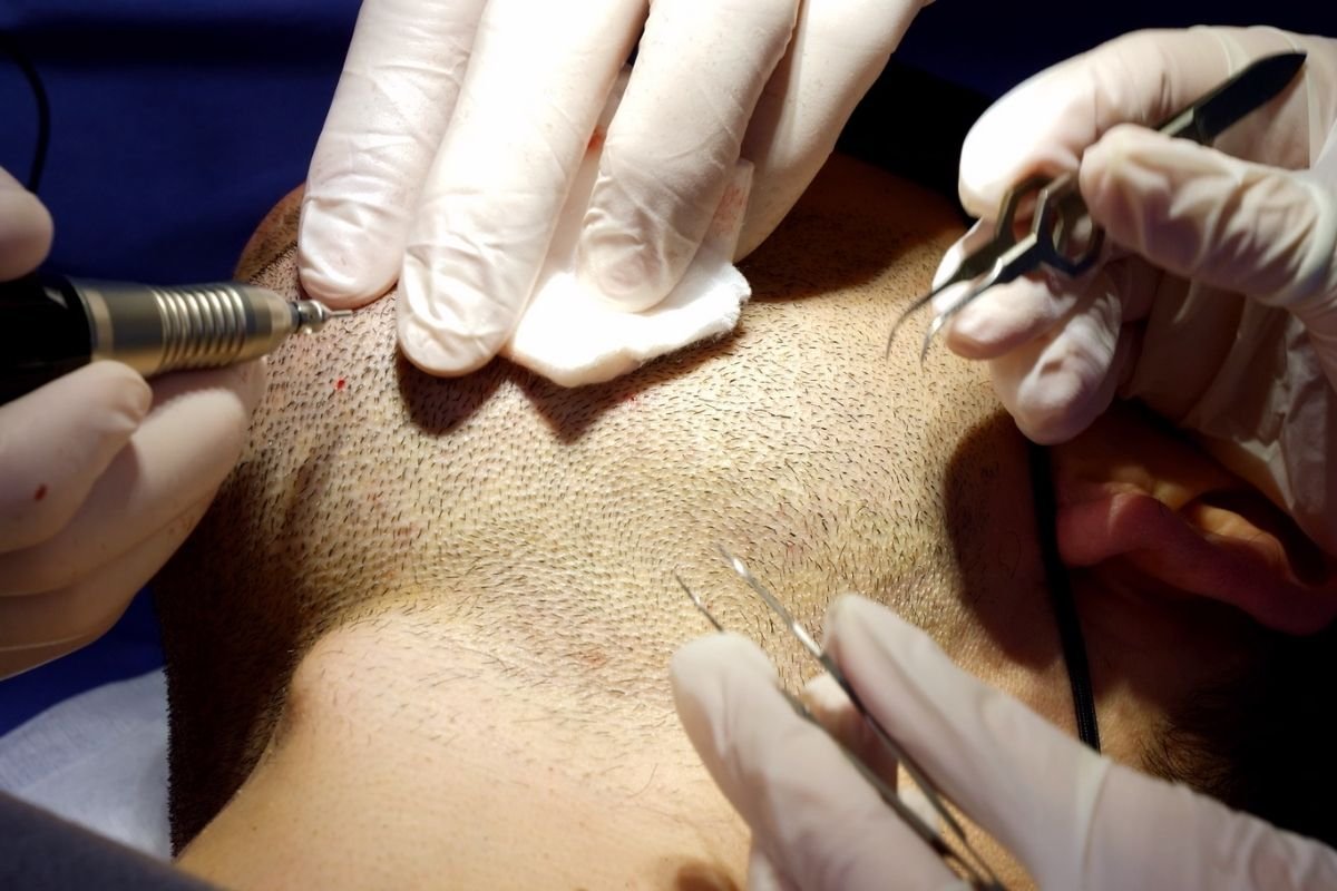Beard Transplant in Madurai
