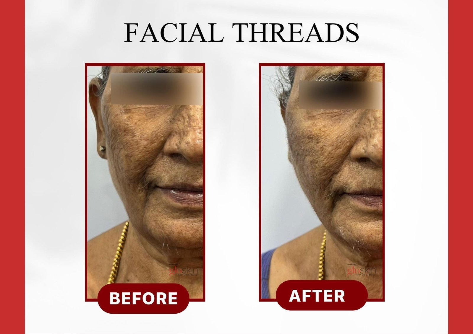 Facial-Threads-2.jpg
