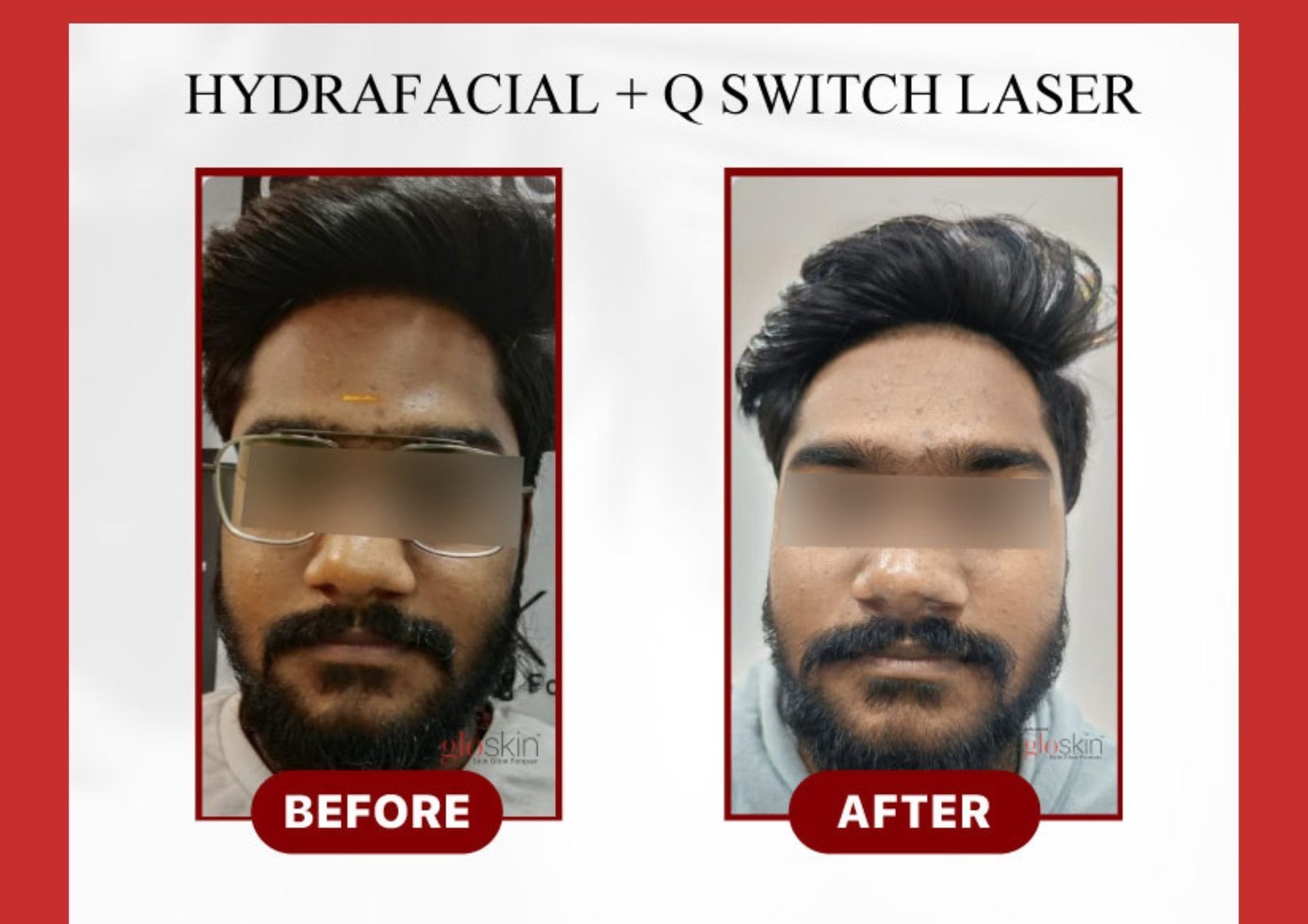 Hydra-Facial-Q-switch-1.jpg