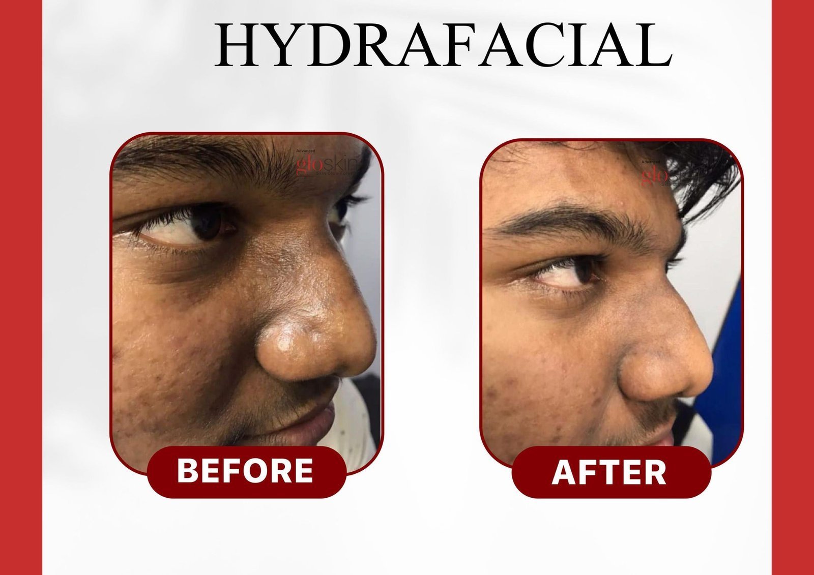 Hydrafacial-2.jpg