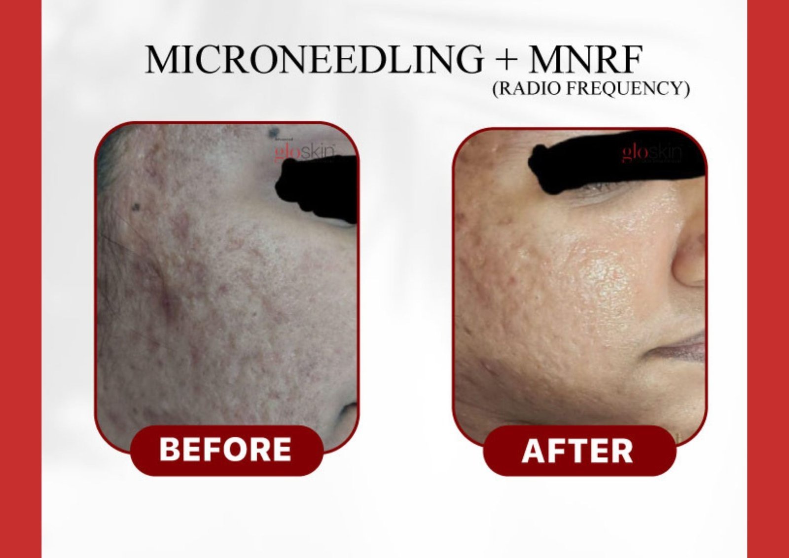 MIcroneedling-MNRF-1.jpg