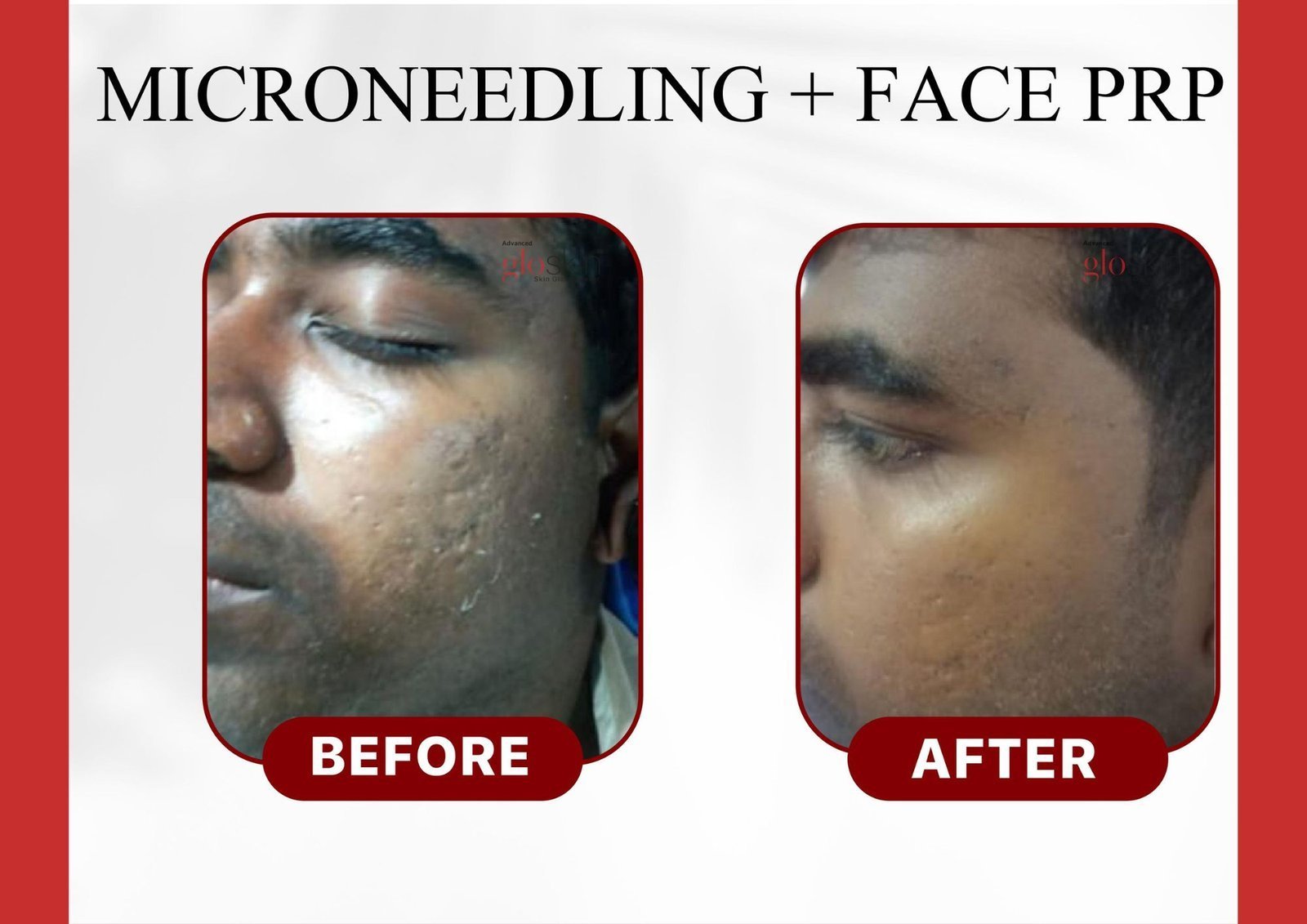 MIcroneedling-face-prp.jpg
