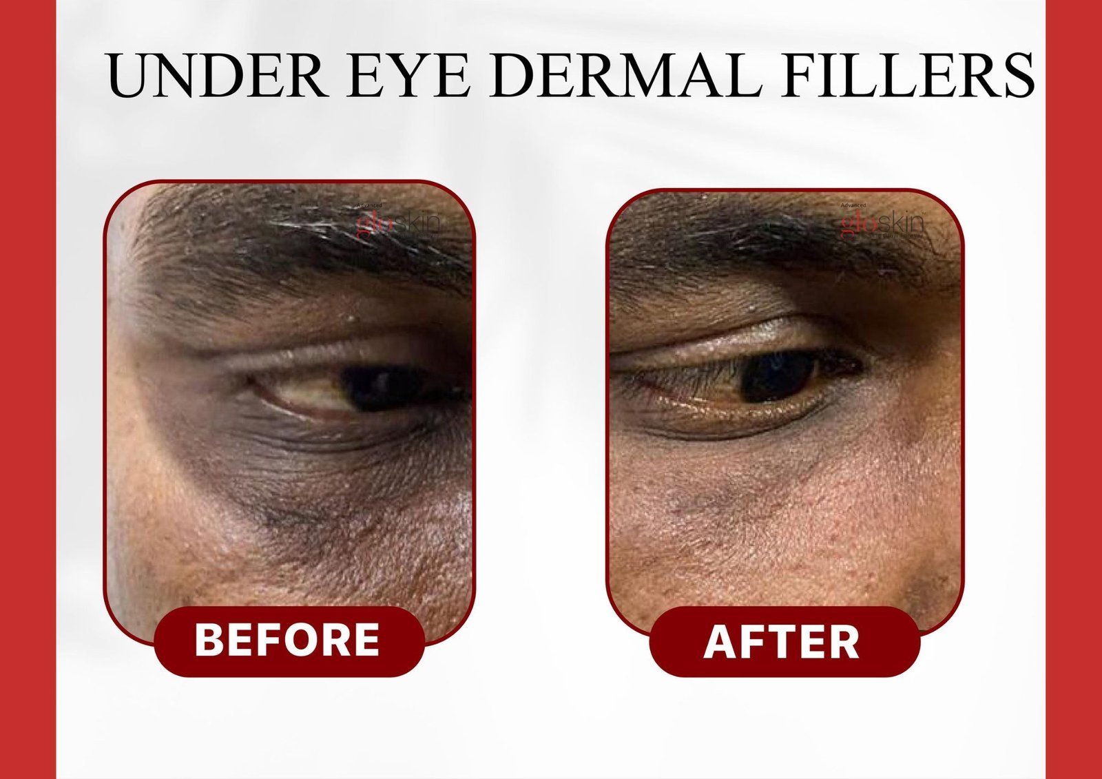 UNder-eye-dermal-fillers.jpg