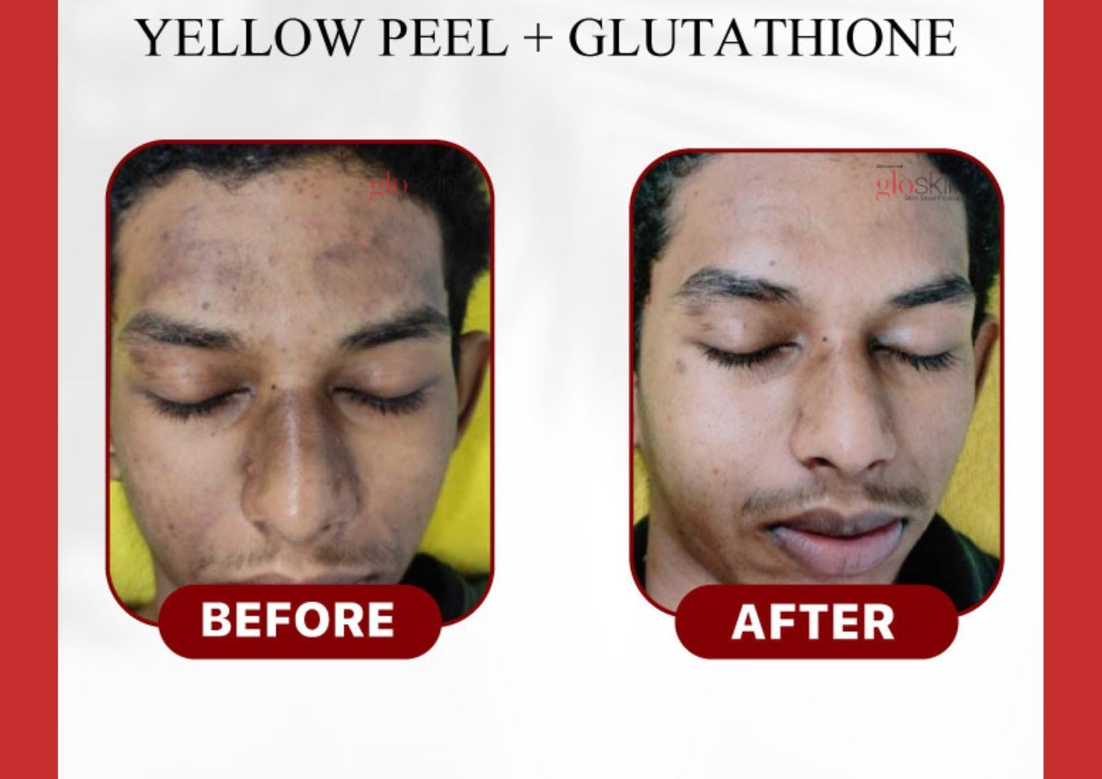 Yellow-peel-glutathione.jpg