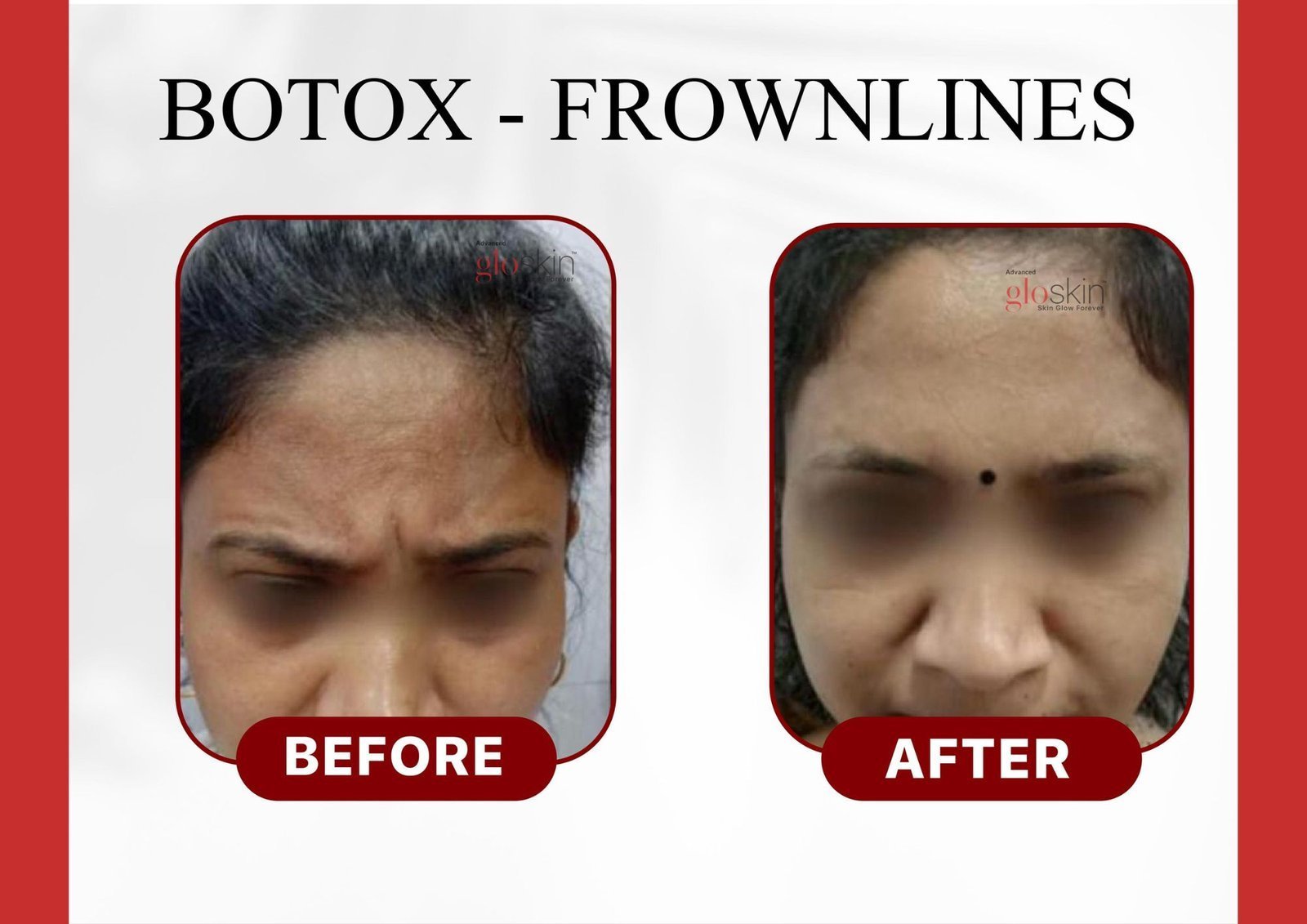 botox-frownlines.jpg