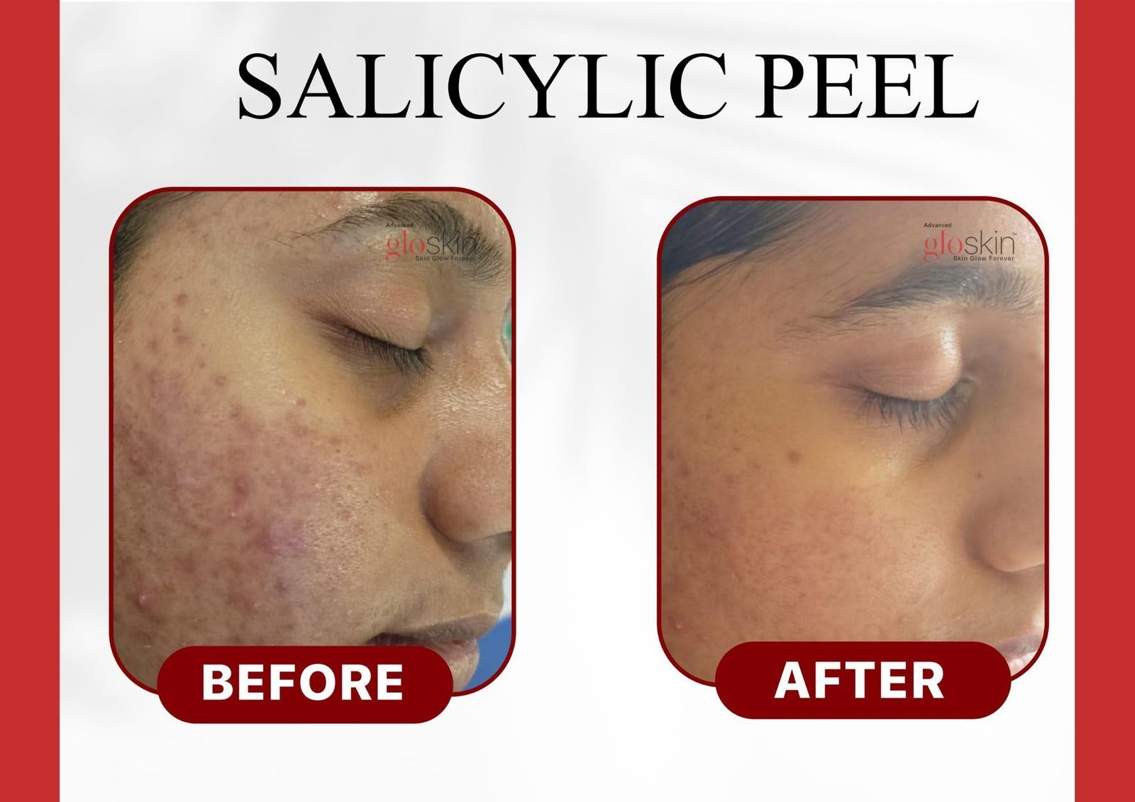 salicylic-peel-2.jpg
