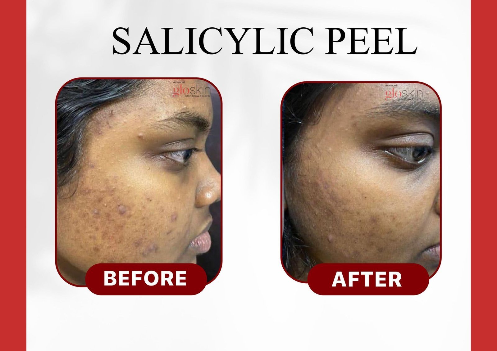 salicylic-peel-3.jpg