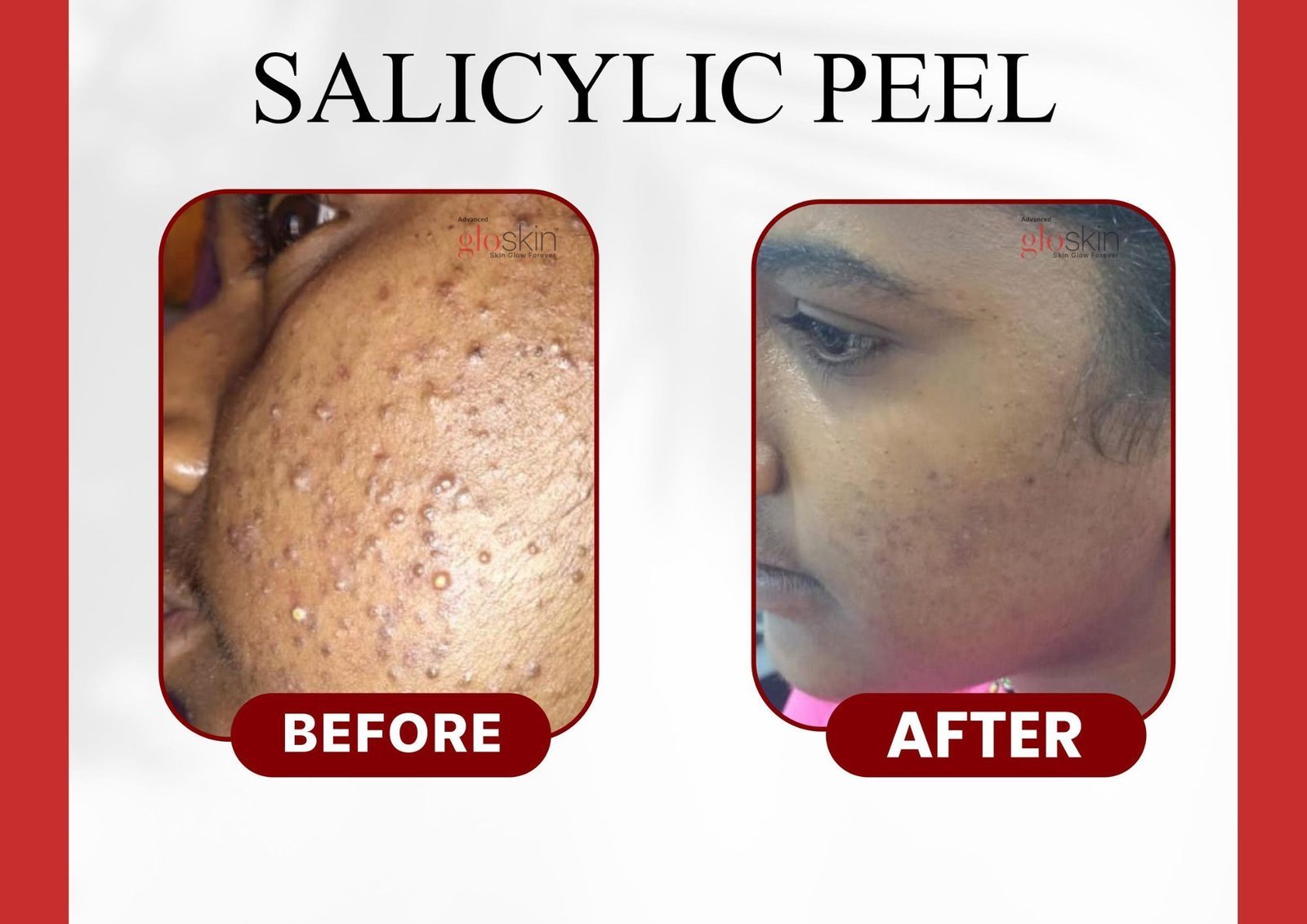 salicylic-peel-4.jpg