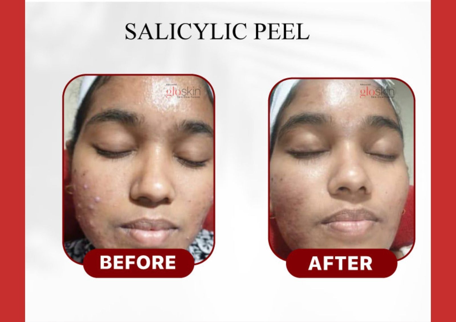 salicylic-peel.jpg