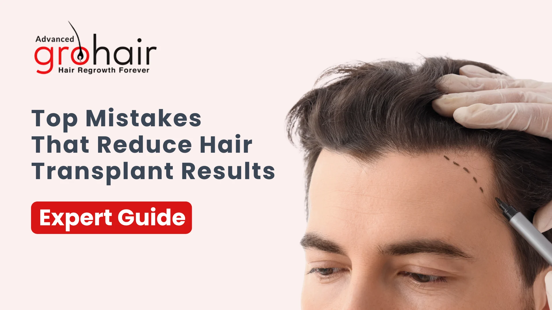 Top Mistakes That Reduce Hair Transplant Results