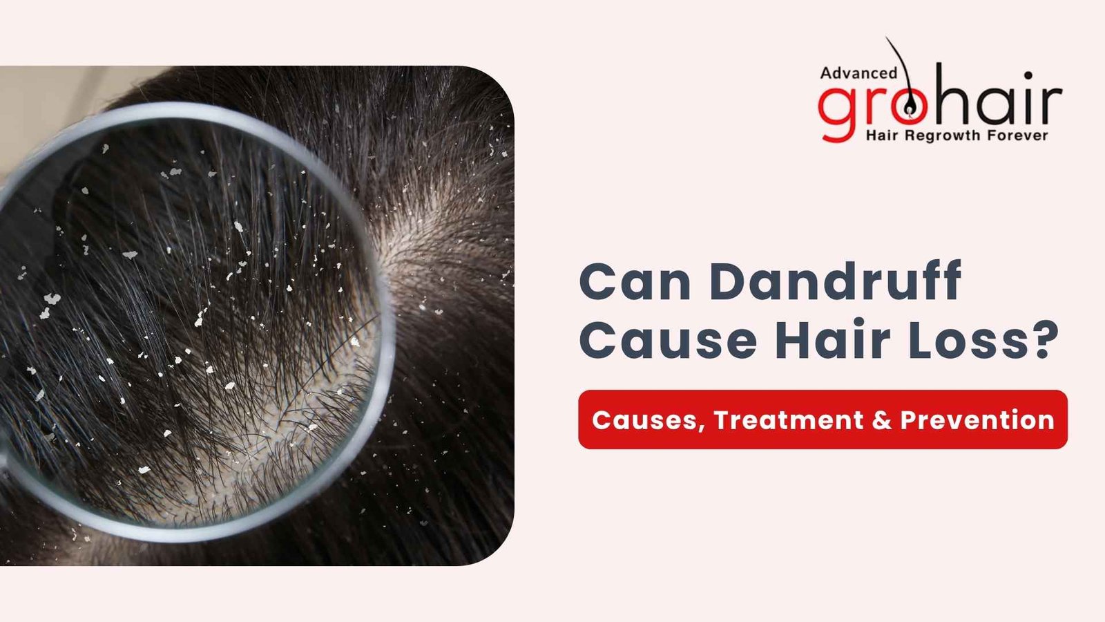 Can Dandruff Cause Hair Loss