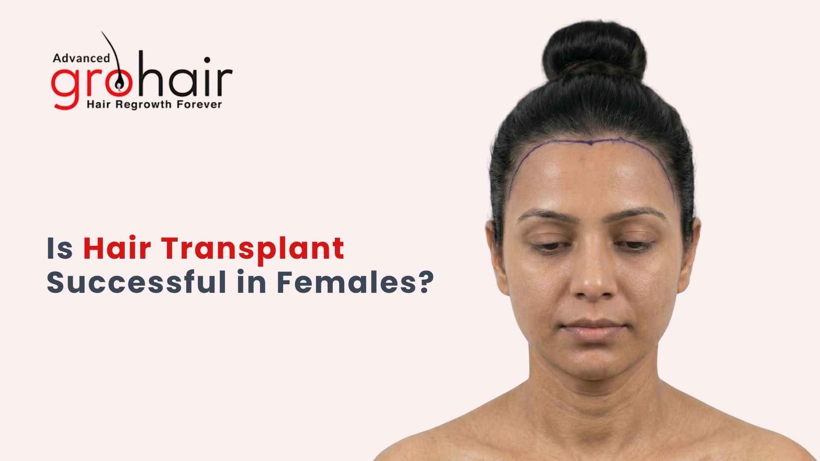 Is Hair Transplant Successful in Females