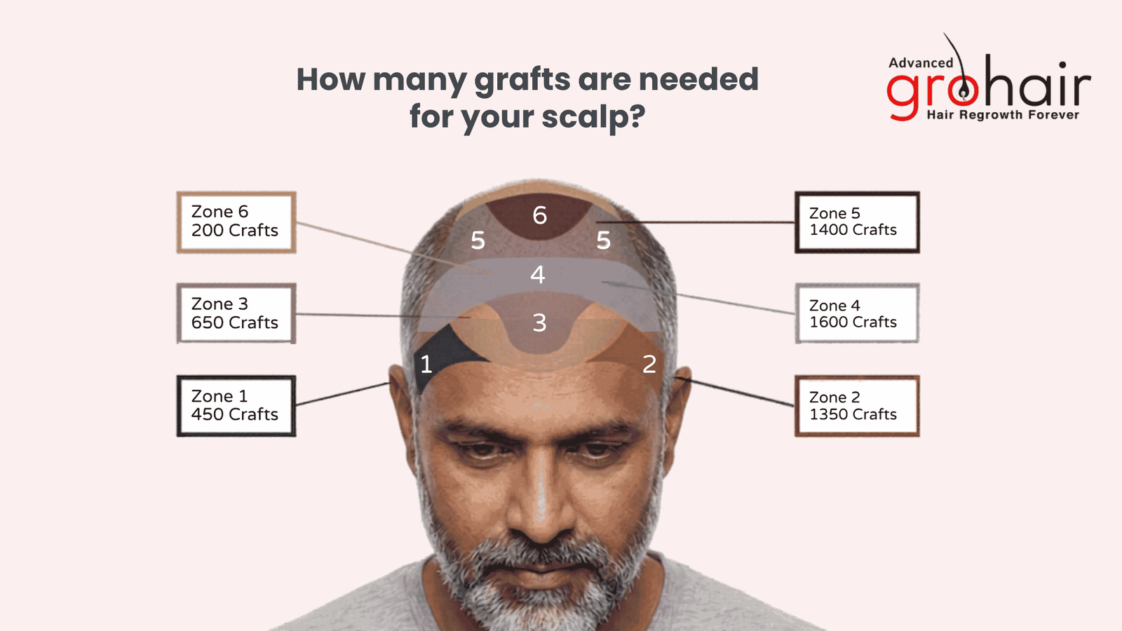 How many grafts are needed for your scalp