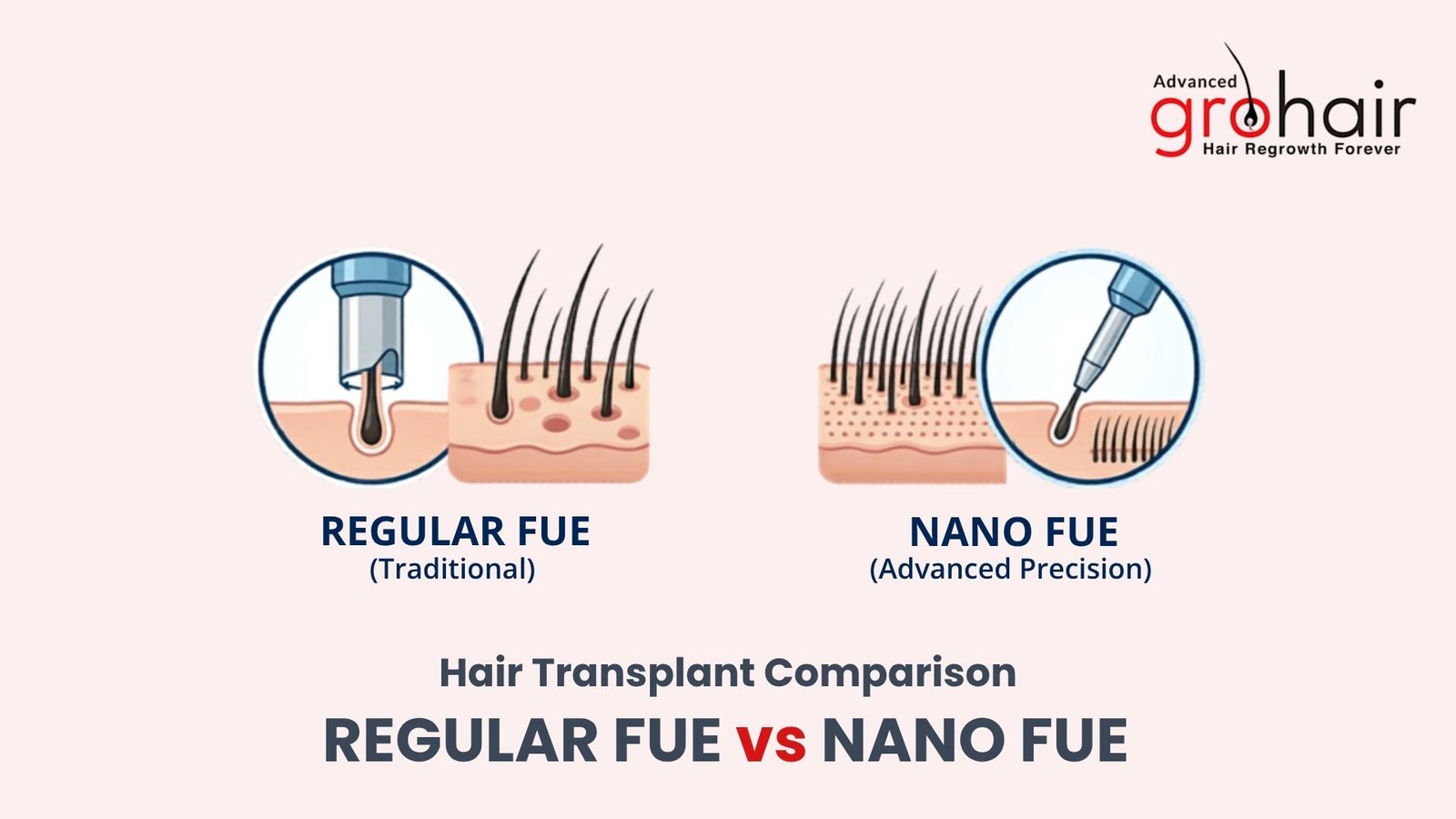 REGULAR FUE vs NANO FUE